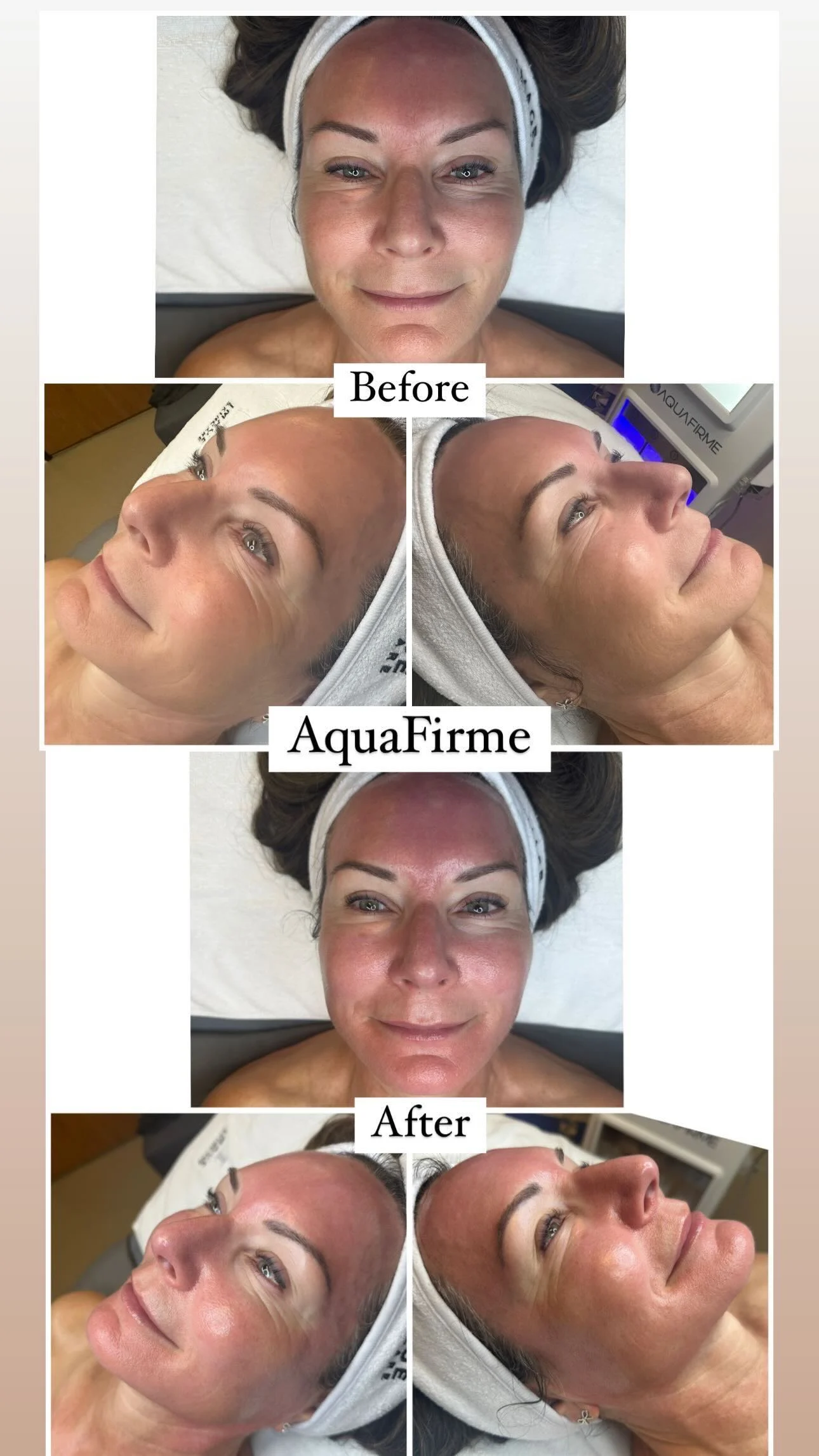 AquaFirme EXO2 before and after result