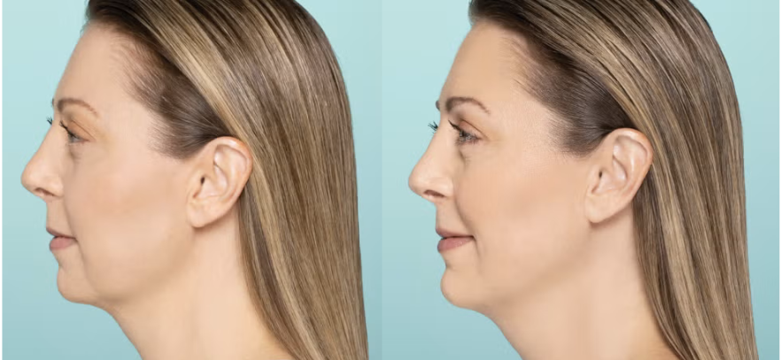 Lifted Snatched Jawline