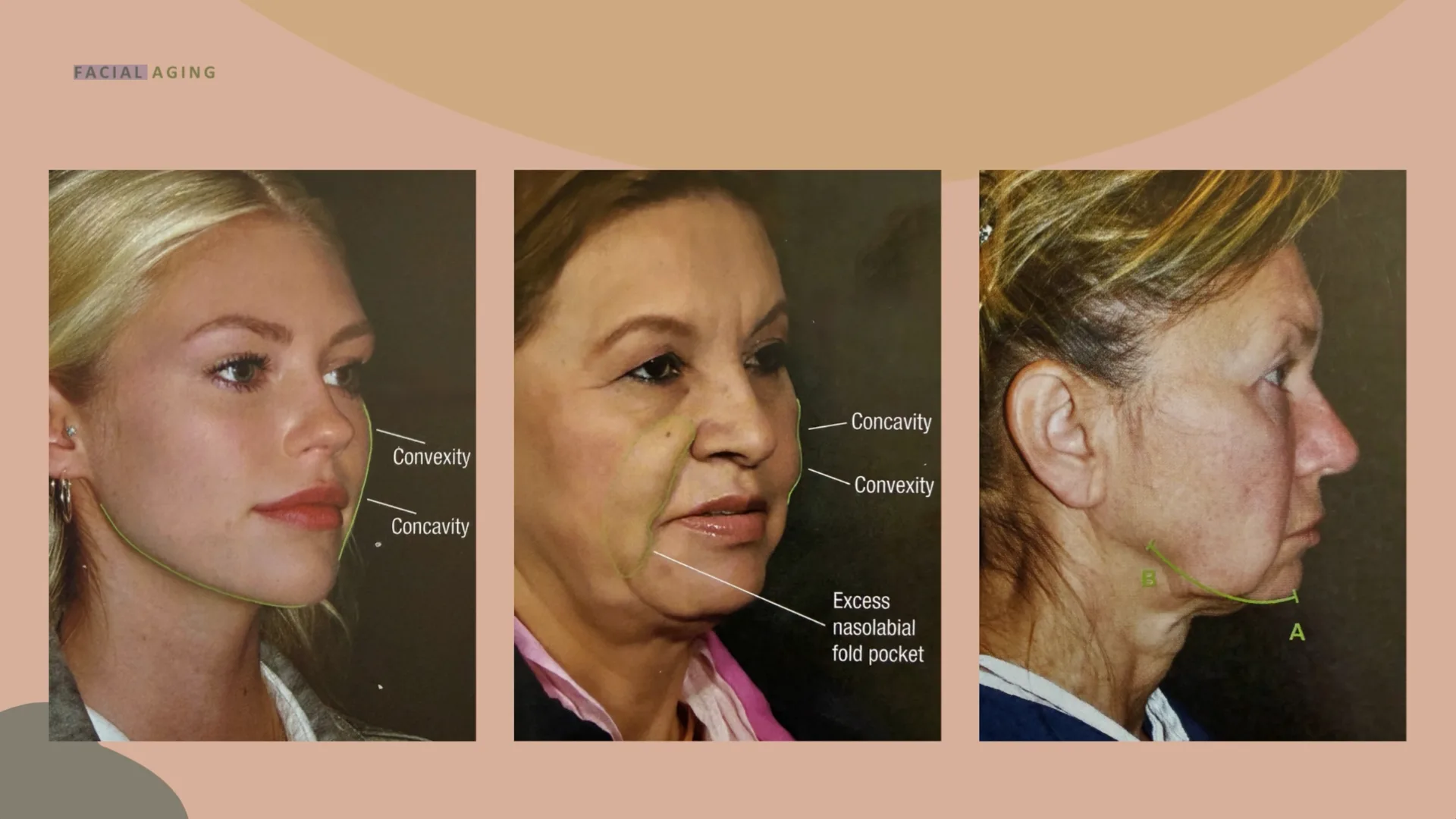 Three faces showing how the cheek and jawline change shape with age, with the convex and concave areas marked