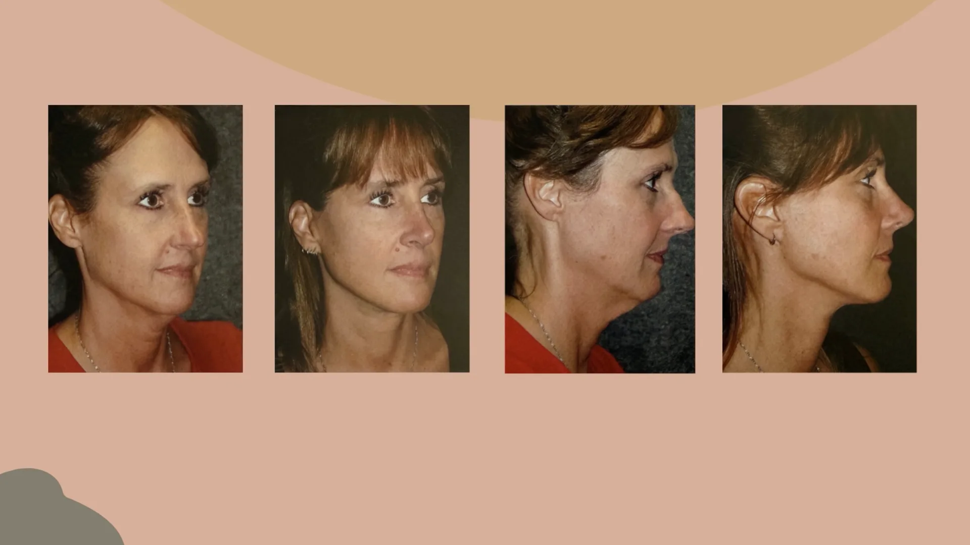 Before and after photos of a facelift patient, shown from the angle and from the side