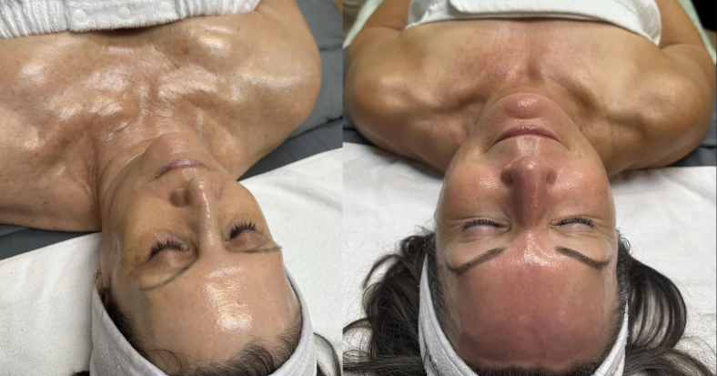 A-PEELE Light, Medium and Forte peels