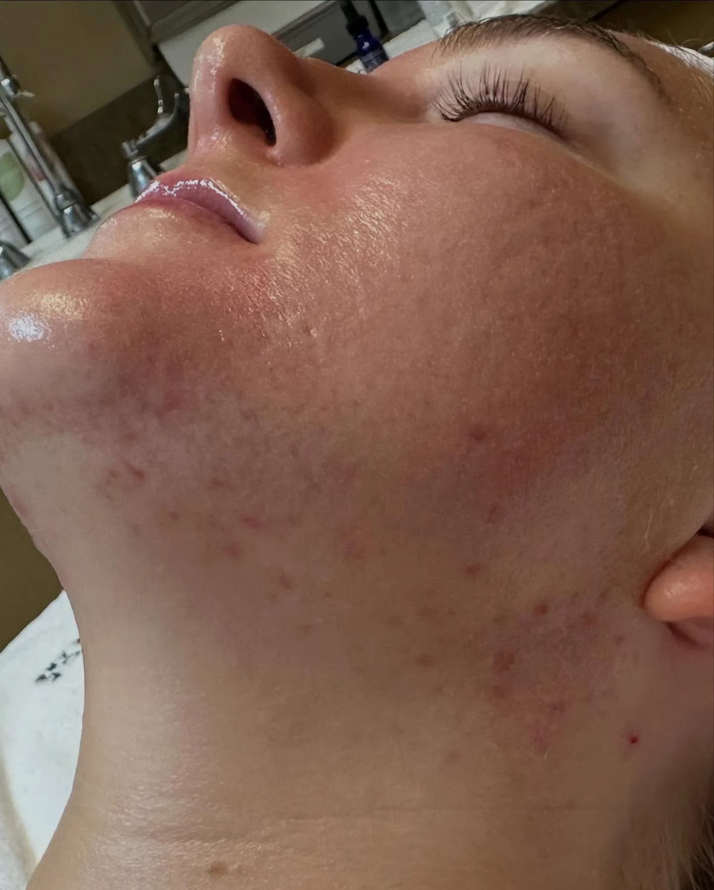 Patient after Chemical Peel for Acne