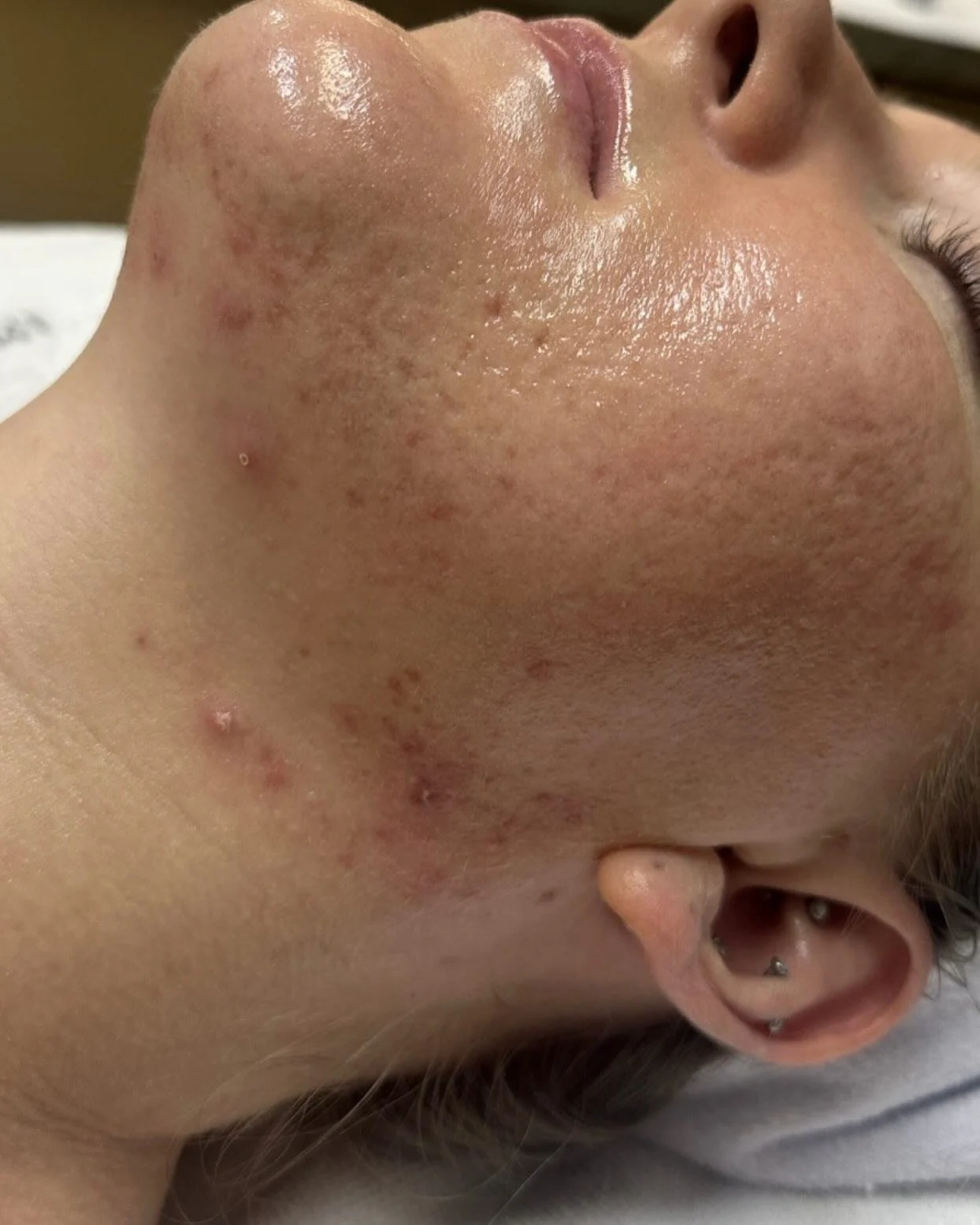 Patient before Chemical Peel for Acne