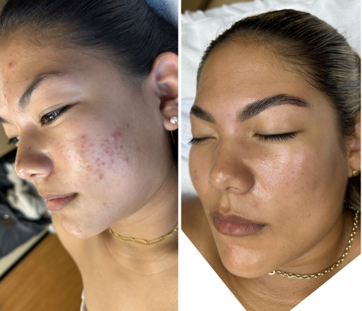 Acne Peel Grades I-II