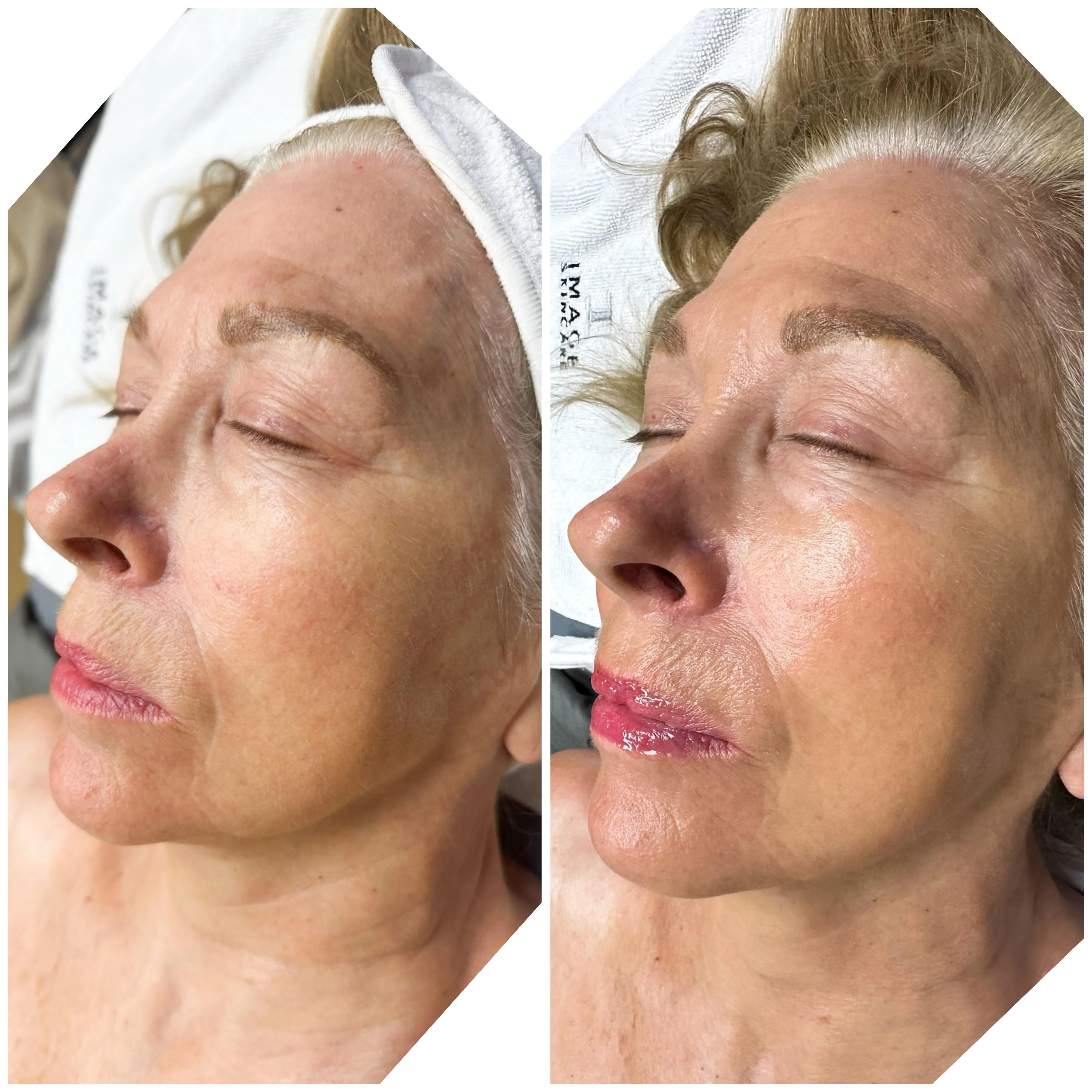 Ormedic Lift (IMAGE Skincare Peel) before and after result