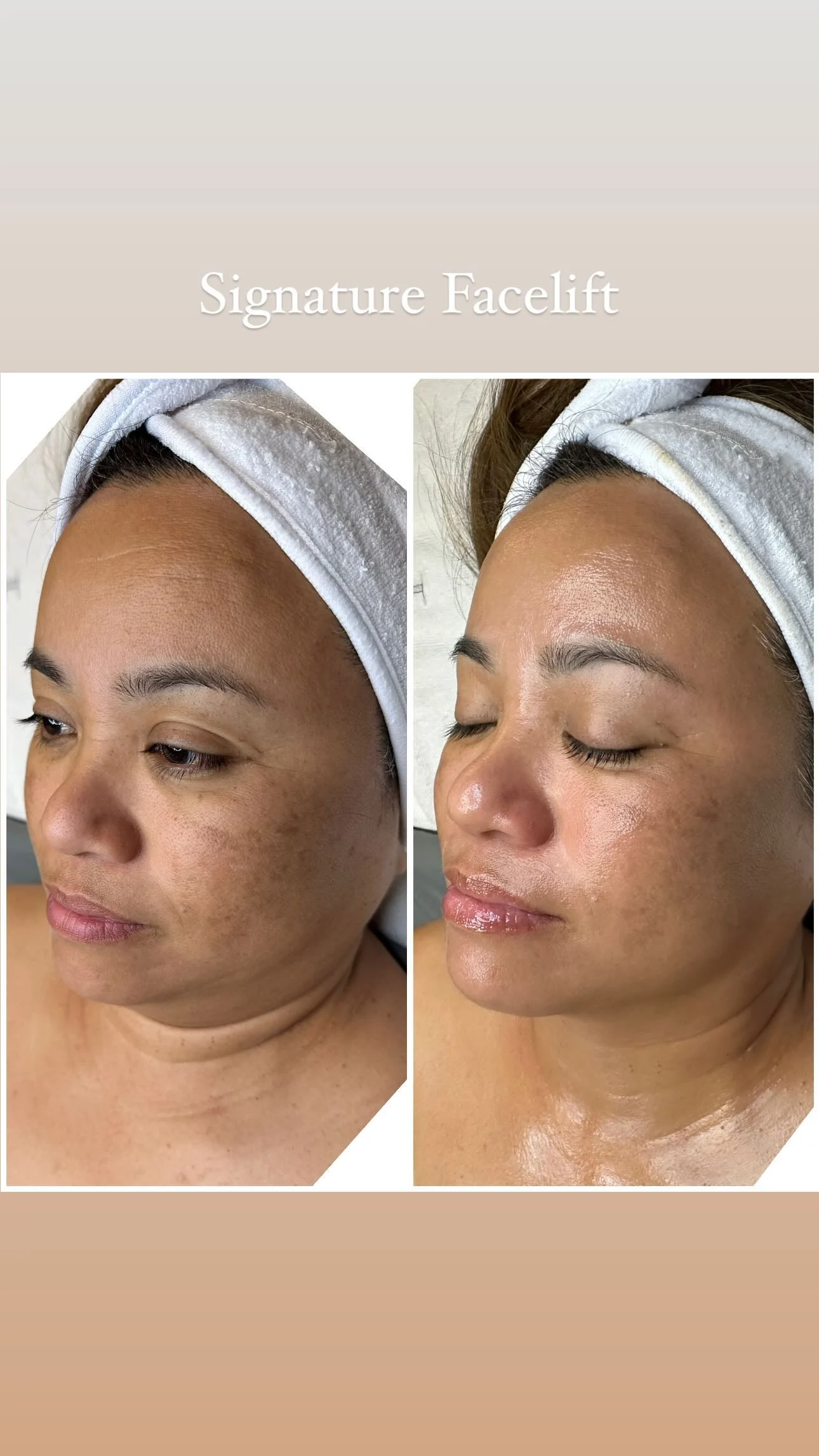 Signature Facelift Treatment before and after result