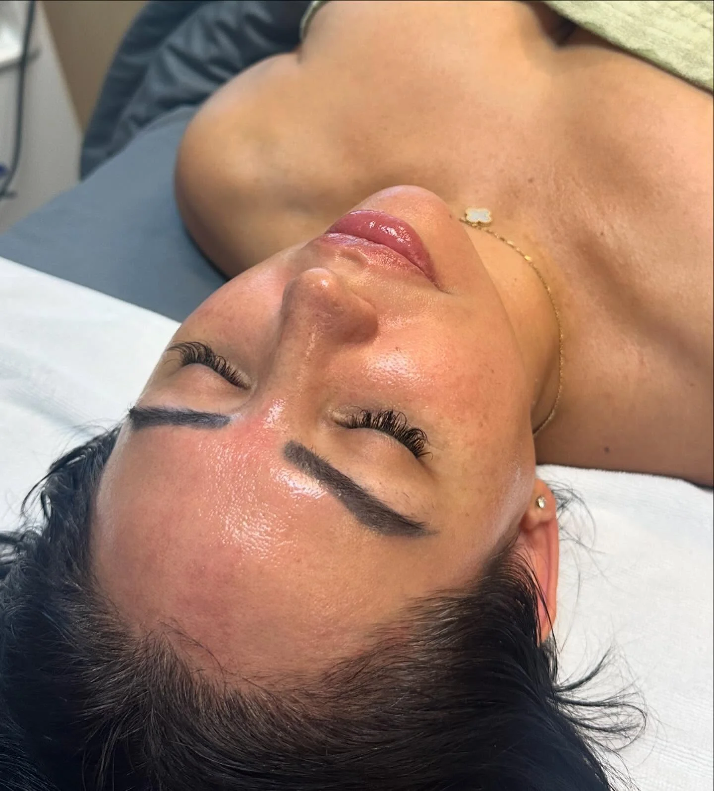 Refreshed, dewy skin after a Signature Facelift treatment