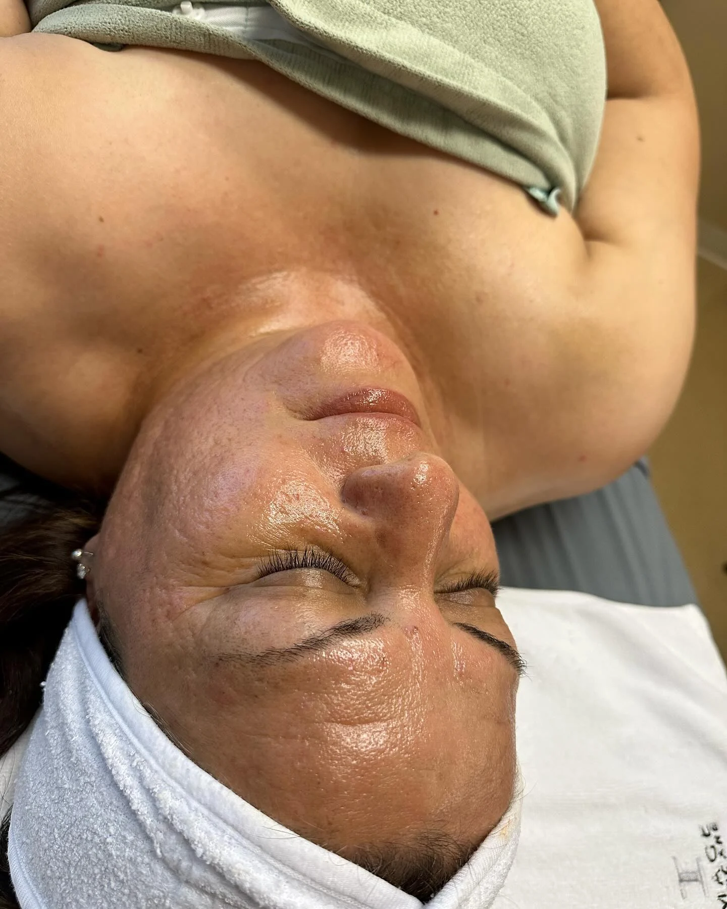 Another client result after a Wrinkle Lift Forte peel