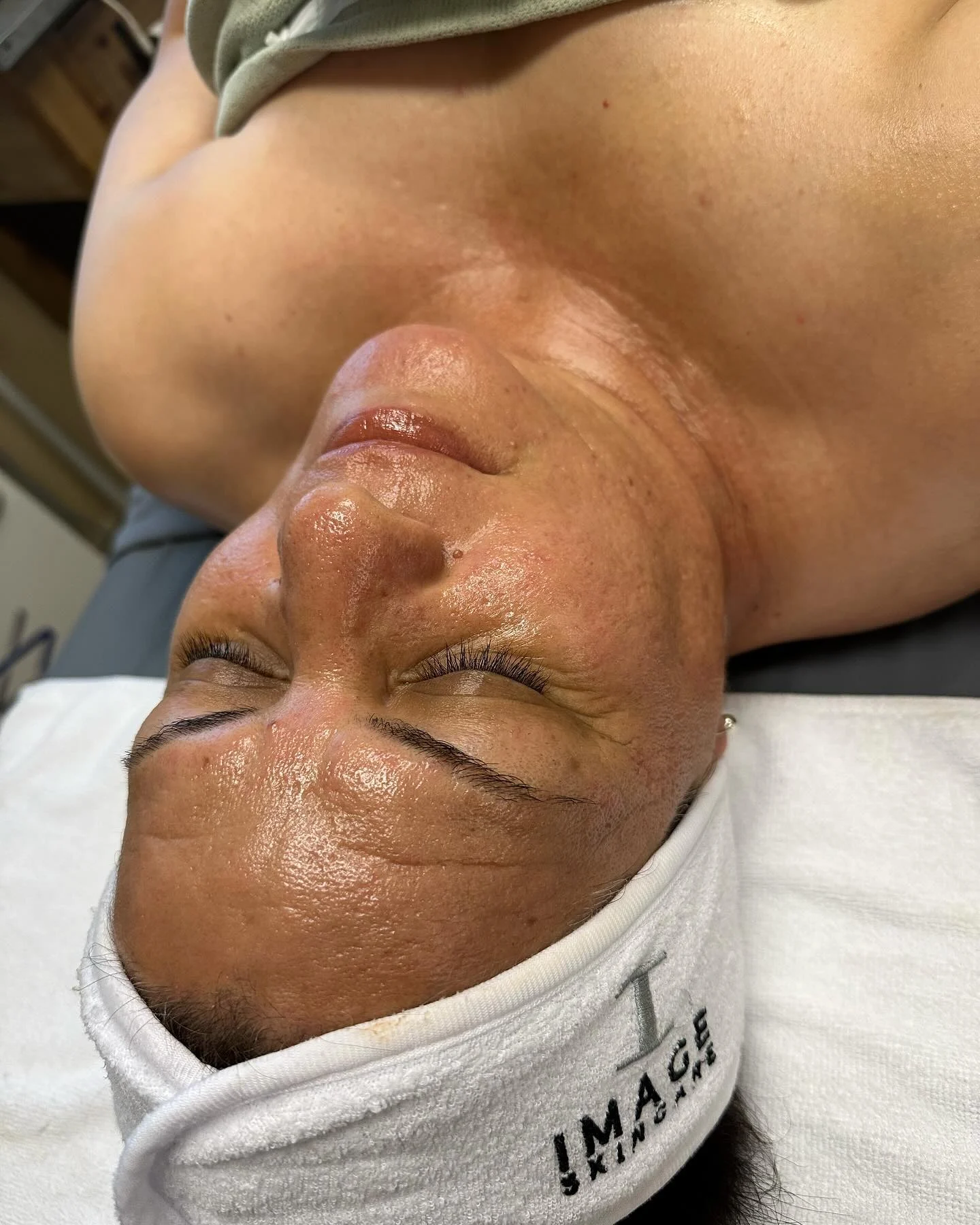 Skin after a Wrinkle Lift Forte peel — softened fine lines, plump and dewy