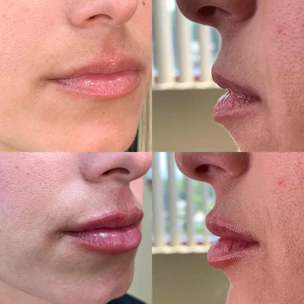 Filler Treatment