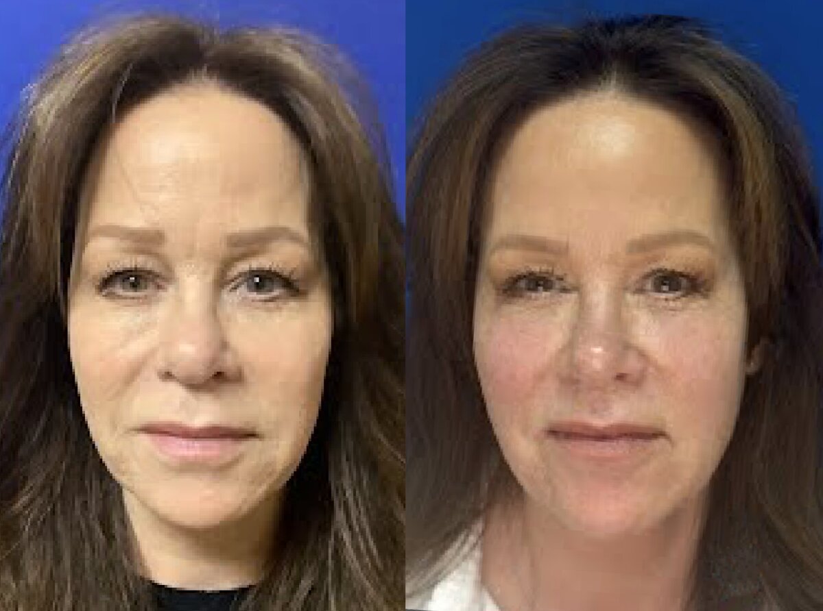 Sculptra® Aesthetic before and after result