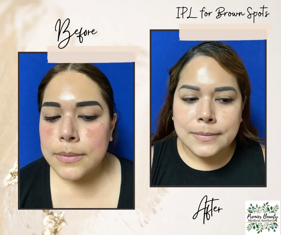 IPL Photofacial