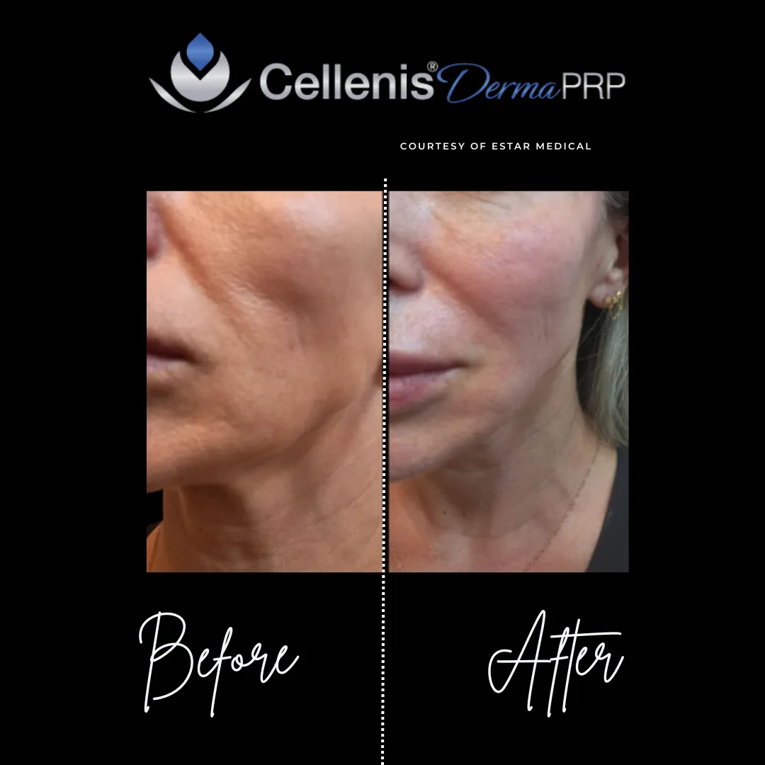 PRP Treatments