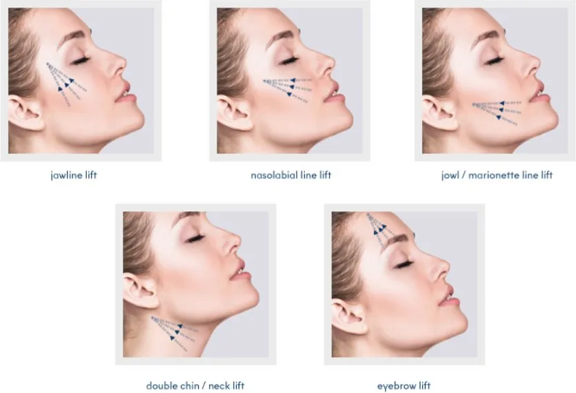 Threadlifts