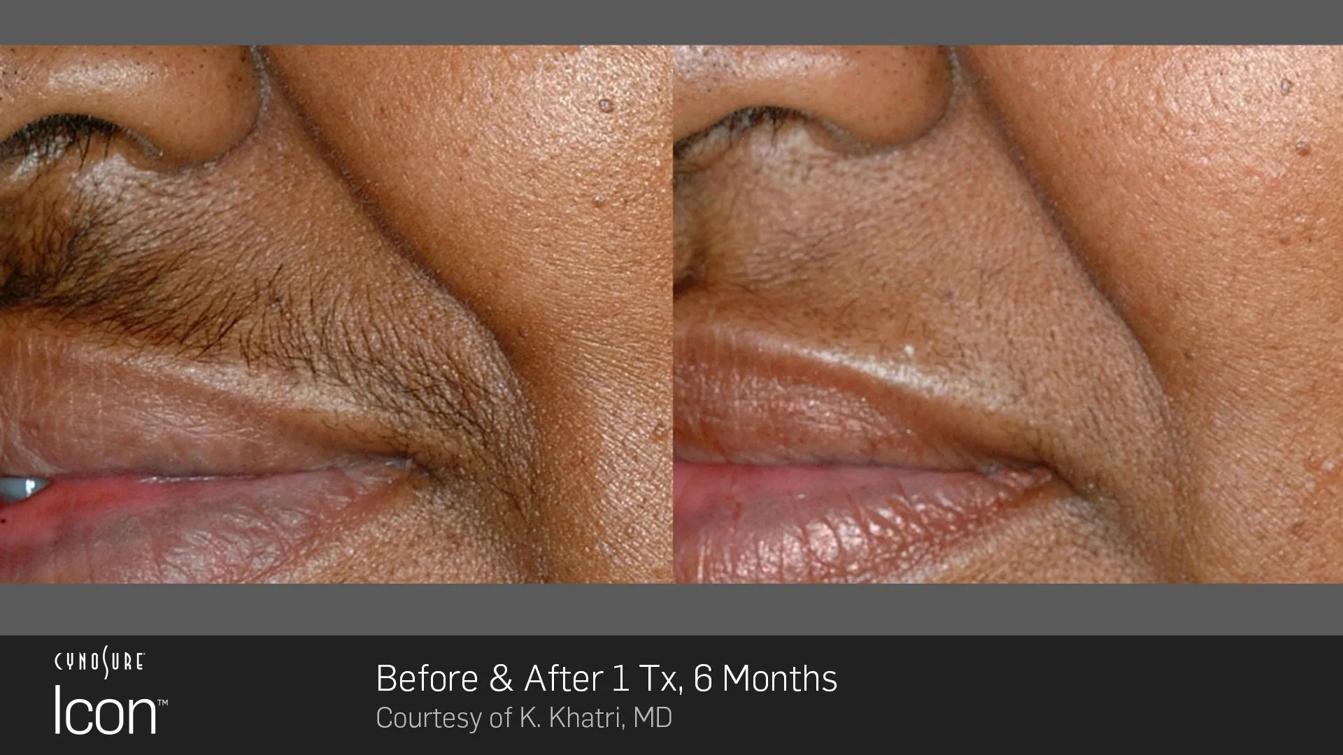 Hair Removal Before and After - Upper Lip Treatment Results
