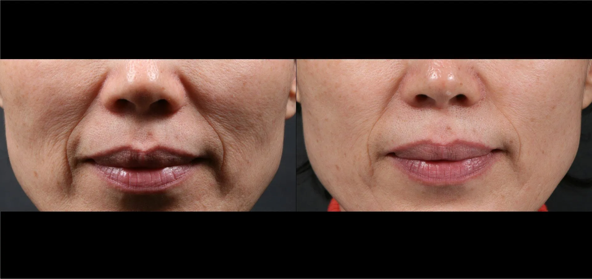 Potenza Microneedling