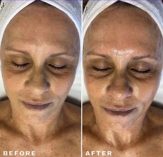 Aquafirme facial treatment before and after showing improved skin health