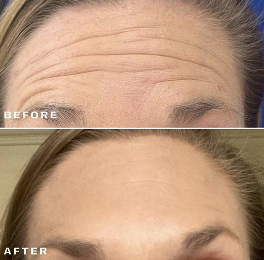 Botox treatment before and after showing reduced forehead wrinkles