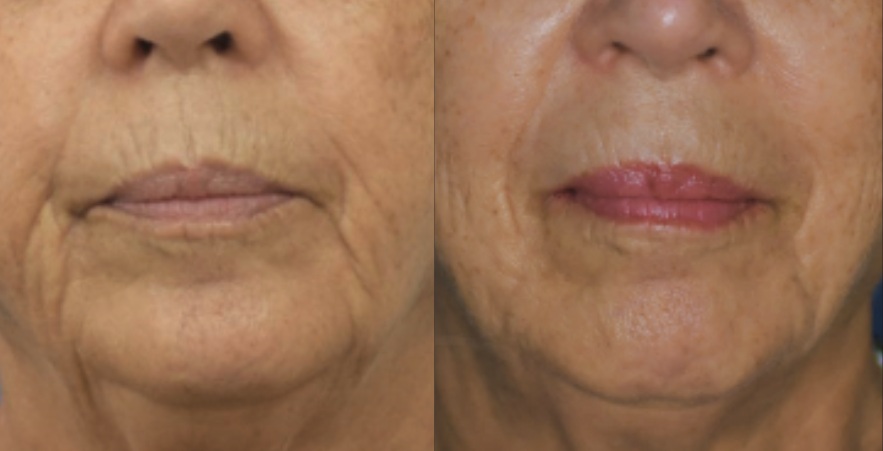 Cellenis Derma treatment before and after showing facial volume restoration