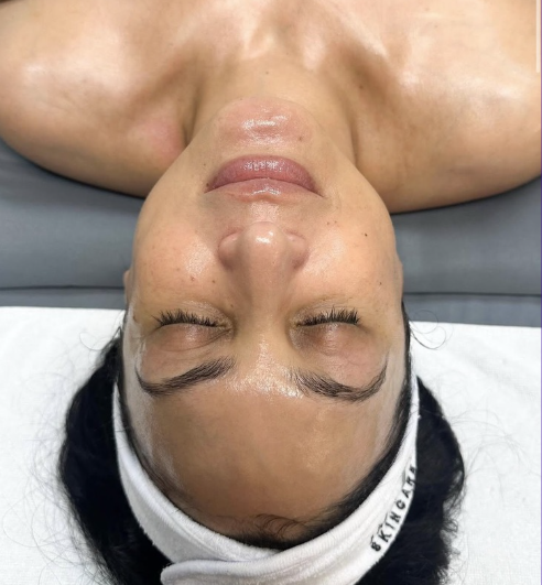 Lightening lift forte facial peel products