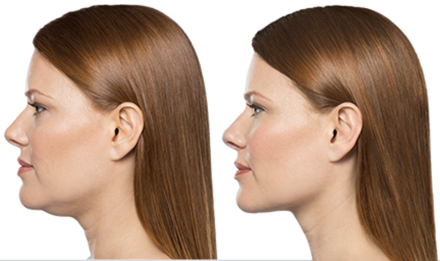 Kybella treatment before and after showing reduced chin fat