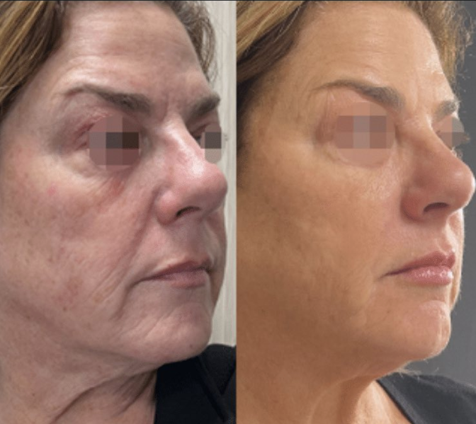 Opus Plasma treatment before and after showing skin resurfacing results