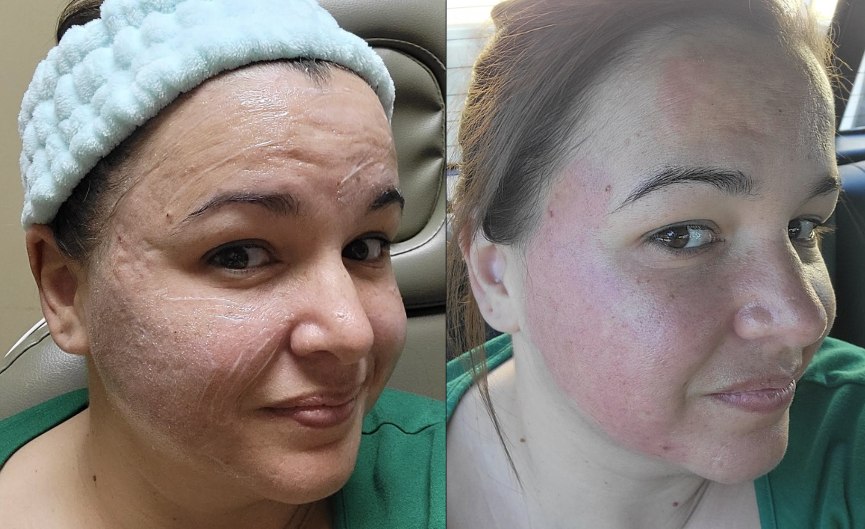Opus Plasma and Sculptra treatment before and after for acne scarring
