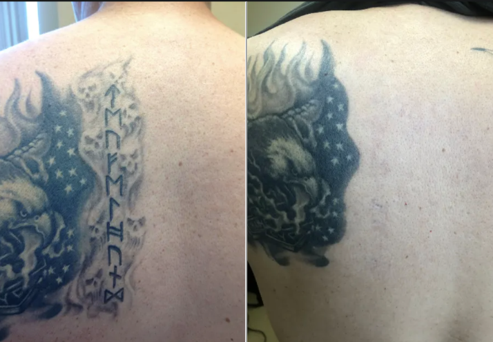 PicoSure laser tattoo removal before and after showing ink removal progress