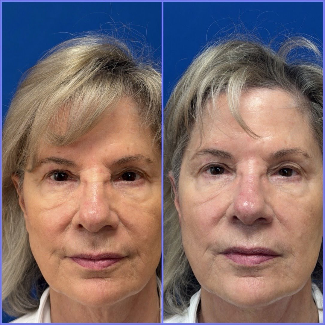 MINT™ PDO Thread Lift before and after result
