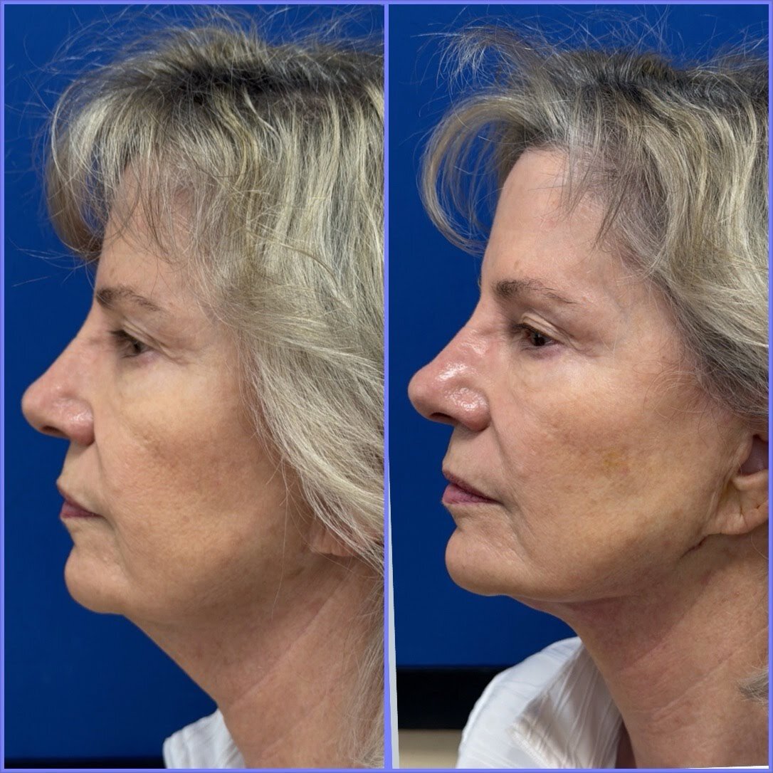 MINT™ PDO Thread Lift before and after result
