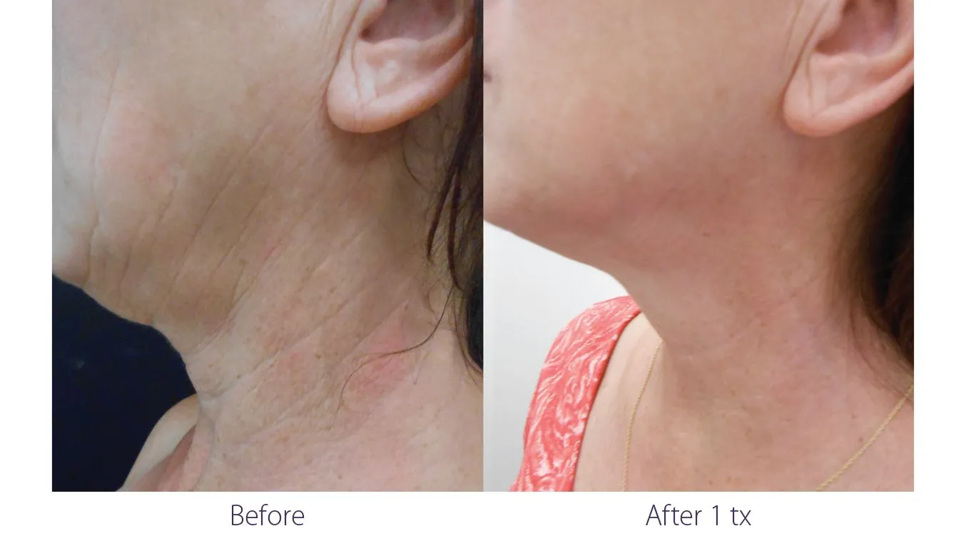 Opus Plasma Body Treatment