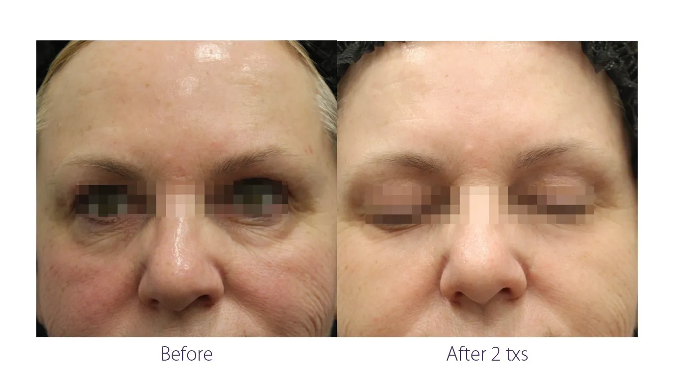 Opus Plasma Results
