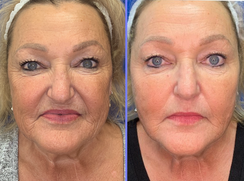 Facial Balancing before and after result