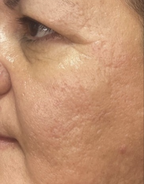 Sara after Opus Plasma Treatment