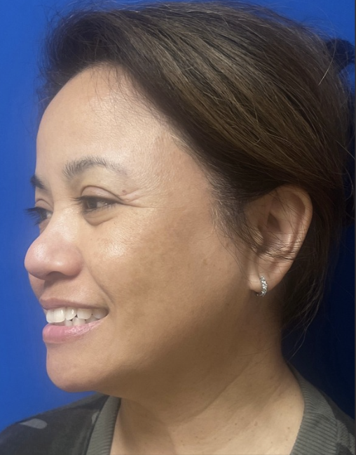 May after PicoSure Laser Treatment