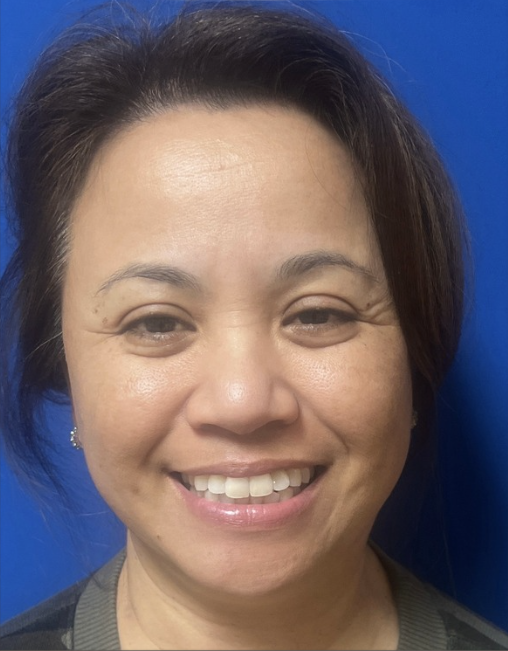 May after PicoSure Laser Treatment