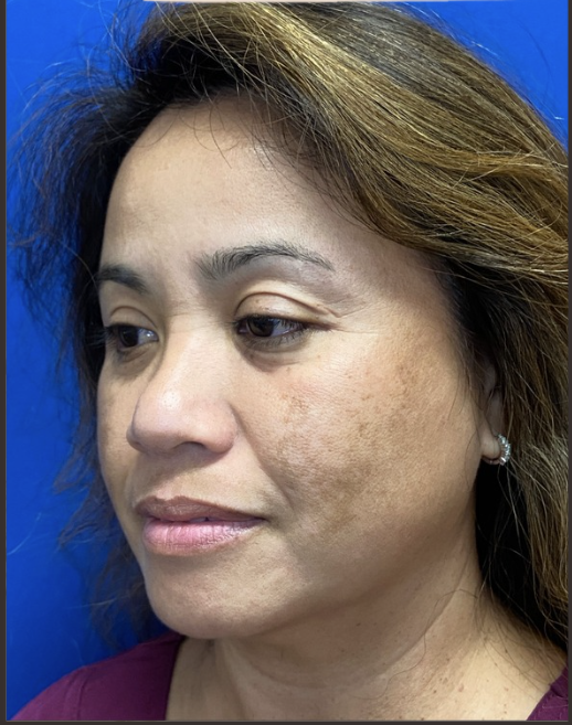 May before PicoSure Laser Treatment
