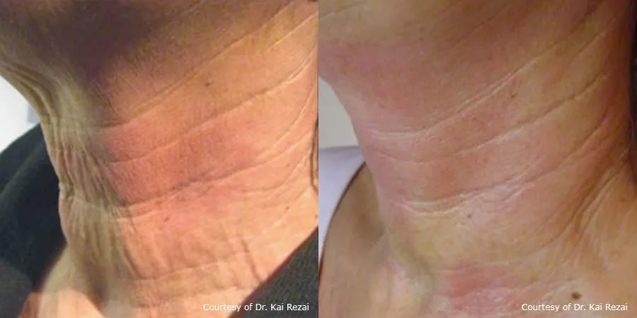 Pellevé Neck Treatment Before and After