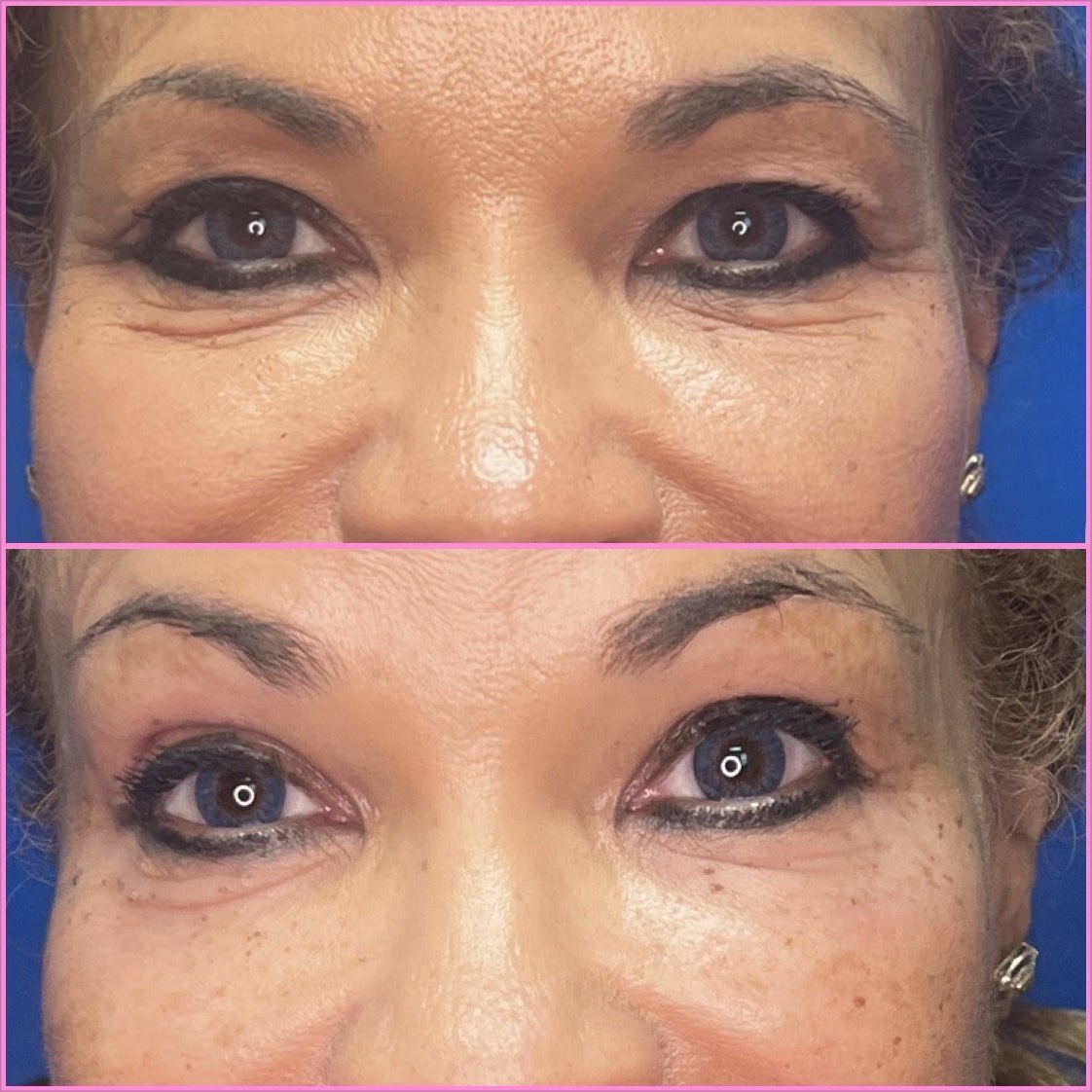Pellevé Eye Area Treatment Before and After