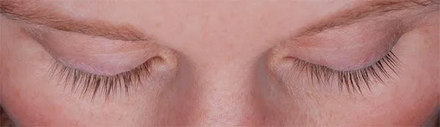 Before SoME Treatment