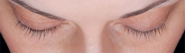 After SoME Treatment