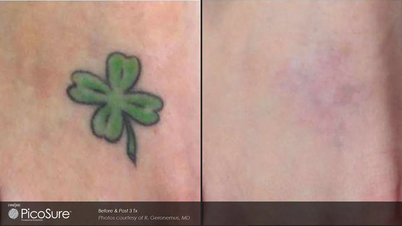 Hair removal before and after photo 2